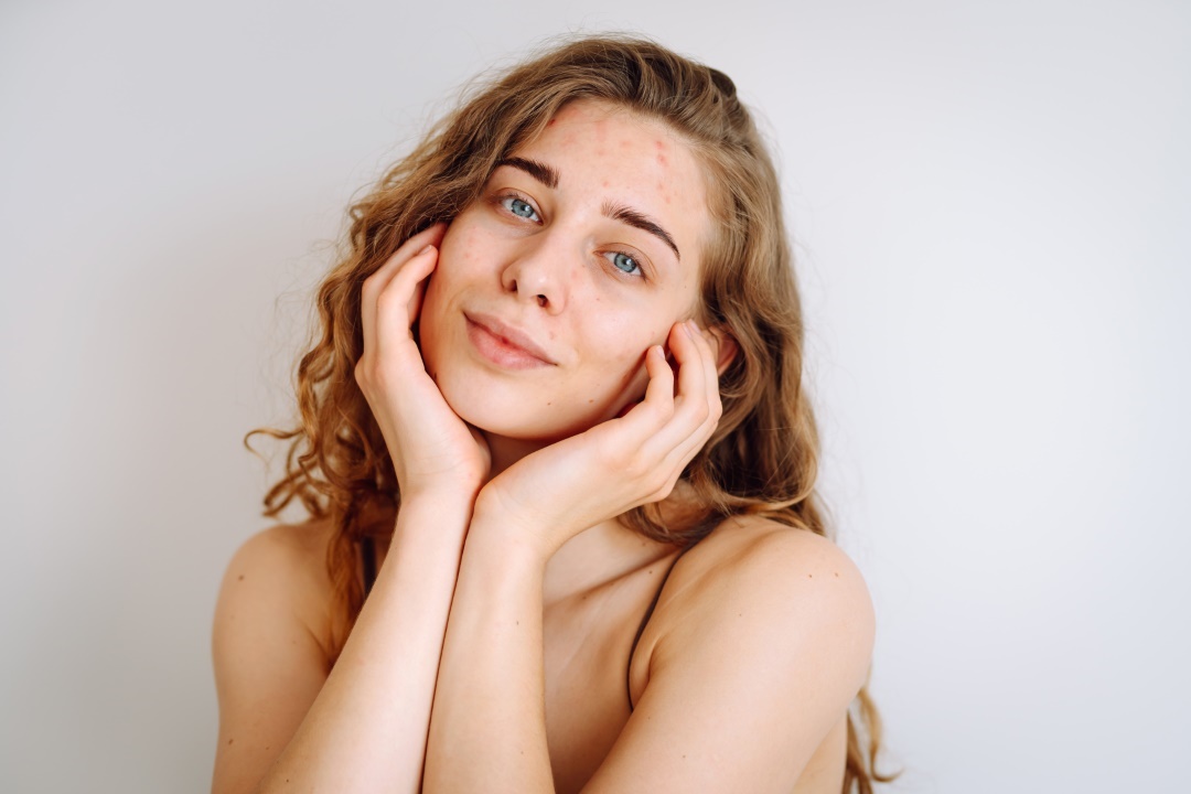 acné et imperfections visage causes solutions 